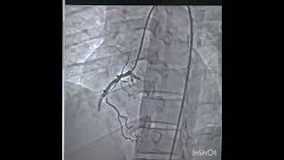 PRIMARY PCI TO RCA GRADE V THROMBUS [upl. by Inahet]