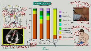 Cardiología  Valvulopatias estenosis aortica insuf aortica estenosis mitral [upl. by Kolodgie39]