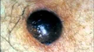 Melanoma what to look for  Dermatology and Laser Center of Charleston [upl. by Llevron]