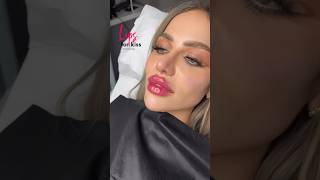 Full face transformation 💉 jawline fullface lips training beauty lipfillers lifting [upl. by Ashli44]