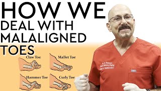 How We Deal with Malaligned Toes aka Hammer Toes [upl. by Barger]