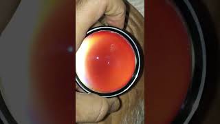 Digital fundoscopy fundus eye retina [upl. by Adnema]