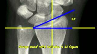 Distal Radius Radiographic Parameters [upl. by Eelir]