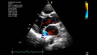 Echocardiographic assessment of the mitral valve [upl. by Gyimah]