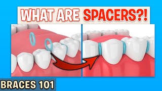 BRACES 101 Spacers For Braces  Treatment Minute Talk [upl. by Aitra]