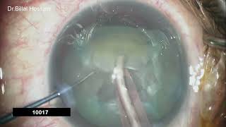 Phacoemulsification with implantation of Monofocal PLUS Lens for Customized Best vision [upl. by Haimerej915]