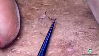 Ultimate Pimple Popping 2024 Best Blackhead Extractions [upl. by Alenson]