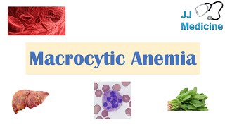 Macrocytic Anemia  Megaloblastic vs NonMegaloblastic  Approach amp Causes [upl. by Anuahsed184]