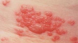 DermTV  Shingles  Herpes Zoster DermTV Epi 425 [upl. by Gwendolyn262]