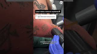 Ever wondered how tattoo removal actually works [upl. by Eimma]