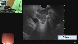 Learning video  Abdominal Lymph nodes linear EUS Dr Vikas Singla [upl. by Hadias]