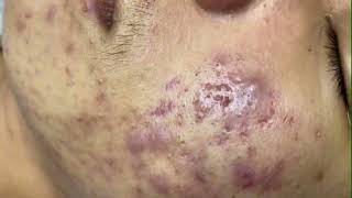 Blackheads amp Whiteheads Removal On Chin Boy 2024 Acne Treatment With Nhat Bang [upl. by Einnol]