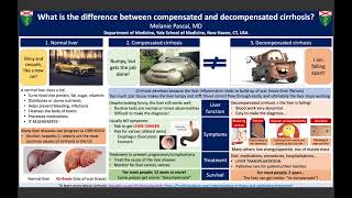 quotWhat is the difference between compensation and decompensated cirrhosisquot  Melanie Pascal [upl. by Rhianon]