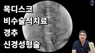 경추 신경성형술 Cervical percutaneous epidural neuroplasty [upl. by Narat]