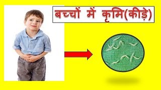 Stomach worms in kidsबच्चों में कृमिकीड़े [upl. by Mcknight82]