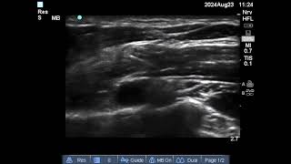 costoclavicular block 23 August 24 [upl. by Balsam]