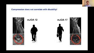 THE EANS WEBINAR DEGENERATIVE CERVICAL MYELOPATHY DCM [upl. by Yentruocal9]