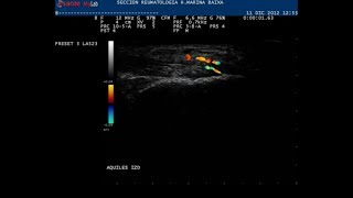 Ultrasound scan achilles enthesitis [upl. by Rolph]