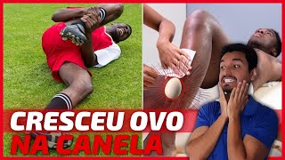 ✅Como Tratar Galo na CANELA😱 Caroço na Canela após Pancada 🕐Quanto TEMPO DURA um Galo na Canela [upl. by Leval]