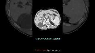 Cholangiocarcinoma  Radiology Everywhere  Radiology Tutorials  radiology [upl. by Kyre]