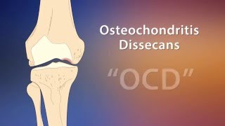 OCD Knee Diagnosis  Scottish Rite for Children Sports Medicine [upl. by Torp898]