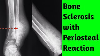 Bone sclerosis with periosteal reaction Differential Diagnosis [upl. by Nob391]