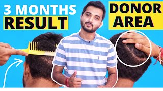 Showing My Donor Area After 3 Months Of Hair Transplant  My FUE Hair Transplant Result [upl. by Barnie]