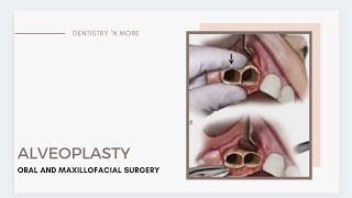 ALVEOLOPLASTY  DEANS ALVEOLOPLASTY  OBWEGESERS ALVEOLOPLASTY  ALVEOLECTOMY [upl. by Wallinga251]