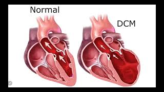 IM Cardiology 16 Cardiomyopathies Dilated cardiomyopathy DCM [upl. by Haleigh]