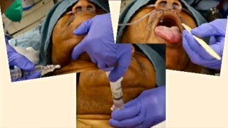 Complete Local Airway Anesthesia for Awake Intubation in 3 Minutes [upl. by Euqinim]