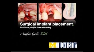 Surgical Implant Placement  by Dr Matt Galli [upl. by Suirtimid]