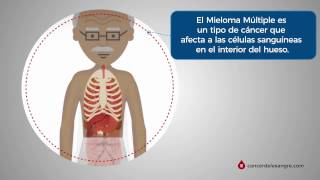 ¿Qué es el Mieloma Múltiple [upl. by Suzi]