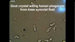 Live Synovial Gout phagocyte Showing Negative Birefringent Characteristic MSU Crystal [upl. by Ynabla]