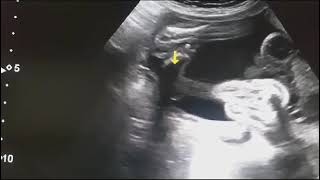 Fetal Anomaly scan Omphalocele with other associated anomalies di watch and subscribe us [upl. by Yelnek]