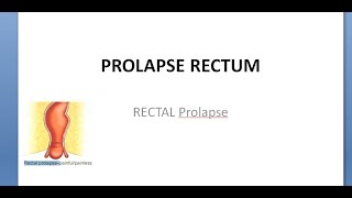 Surgery Rectal prolapse rectum Procidentia Intussuception [upl. by Sydalg]