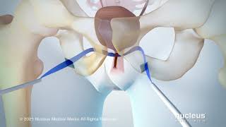 Urinary Incontinence Transobturator Tape TOT Procedure [upl. by Emmery]