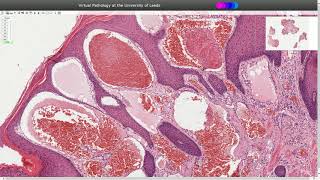 Angiokeratoma  Histopathology [upl. by Lexis699]