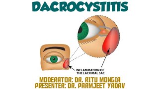 Dacryocystitis  Symptoms  Causes  Treatment [upl. by Yesnil]