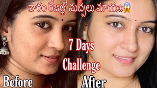 7 Days Challenge  Remove Pimple Marks amp Acne Scars Naturally at Home  మొటిమలు మచ్చలు తగ్గాలంటే [upl. by Sams]