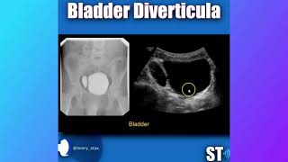 Bladder Diverticulum [upl. by Chi]