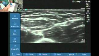 How to find nerves for axillary block [upl. by Zobe]