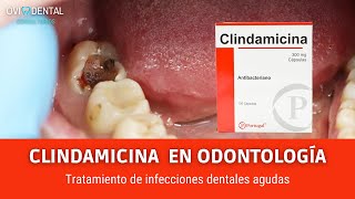 CLINDAMICINA PARA EL TRATAMIENTO DE INFECCIONES DENTALES AGUDAS [upl. by Wieche]