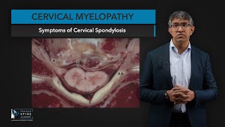 Cervical Myelopathy What You Need to Know [upl. by Byrd700]