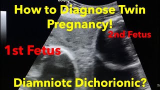 Twin Pregnancy  Diamniotic Dichorionic how to diagnose  easy steps [upl. by Gurney402]