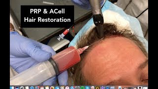 PRP amp ACell Hair Restoration  Dr Weiner Narrates His Own Treatment [upl. by Sirahc]