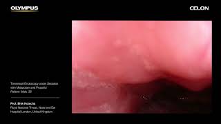 Drug Induced Sleep Endoscopy with CELON  Prof Bhik Kotecha  Part 3 [upl. by Nus]