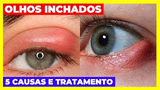 OLHOS INCHADOS DESCUBRA AS 5 PRINCIPAIS CAUSAS E COMO TRATÁLAS [upl. by Assyn]