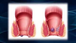 Bleeding Per Rectum in Children  Examination  Causes  Management  Dr Armaghan Ahmed [upl. by Ymer258]