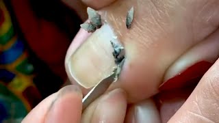 HOW TO CUT THICK TOENAILS  Toenail Cleaning Satisfying 22 [upl. by Ellehcan]