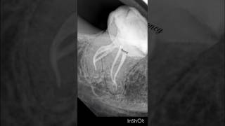 Mandibular Third molar with severe curvature molar rct  short curvature endodontics [upl. by Ahcmis]